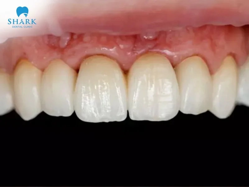 Dark margins around crowns after orthodontic treatment can result from the crown material or improper oral care