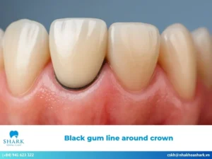 Black gum line around crown