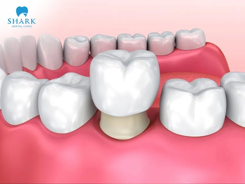 Anatomical crown uses a crown crafted in the shape of the natural tooth, extending from the gumline to the tip of the tooth.
