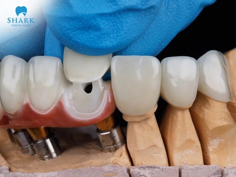 Clinical crown uses a porcelain crown crafted to cover the portion of the tooth above the gumline, designed based on the actual condition of the tooth.
