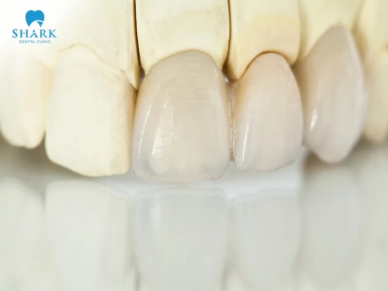 There are two common types of porcelain crowns to choose from: metal-ceramic and all-ceramic crowns