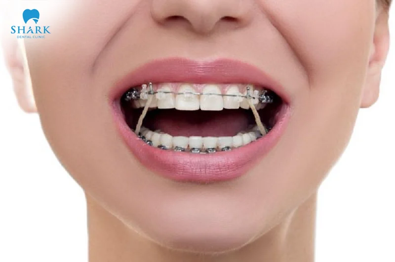 Braces rubber bands are appliances used to guide teeth to move in the correct direction