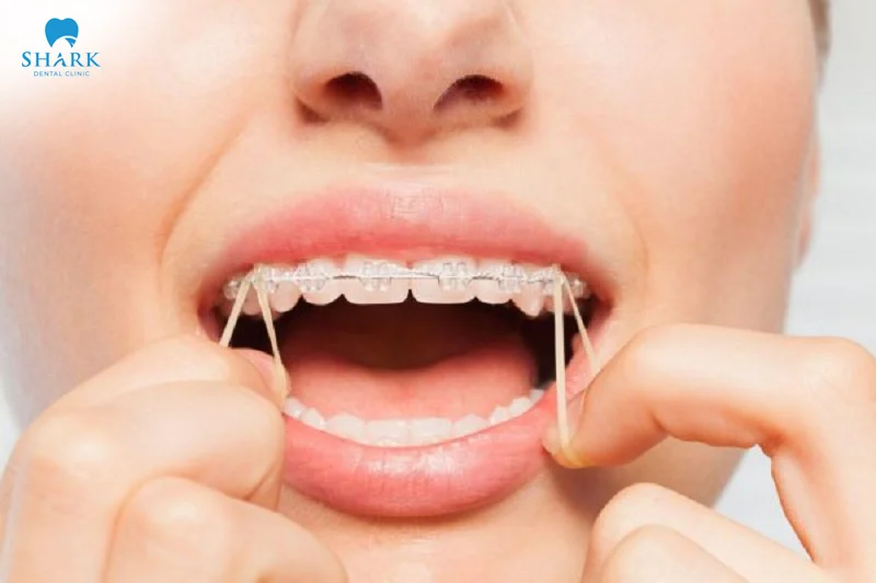 You should wear orthodontic rubber bands correctly to achieve the best possible results from your braces treat