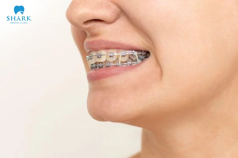 In the early stage of wearing orthodontic rubber bands, there may be a slight aching or discomfort