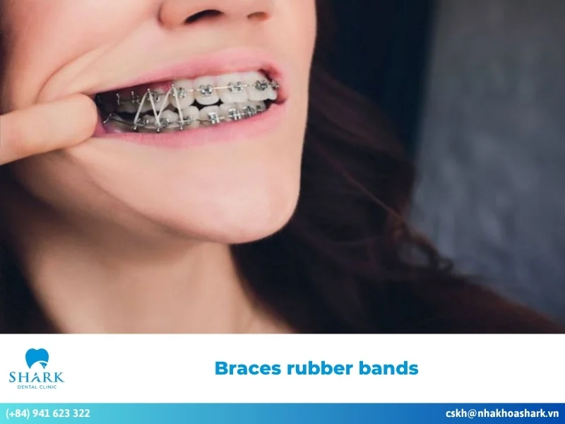 Braces rubber bands