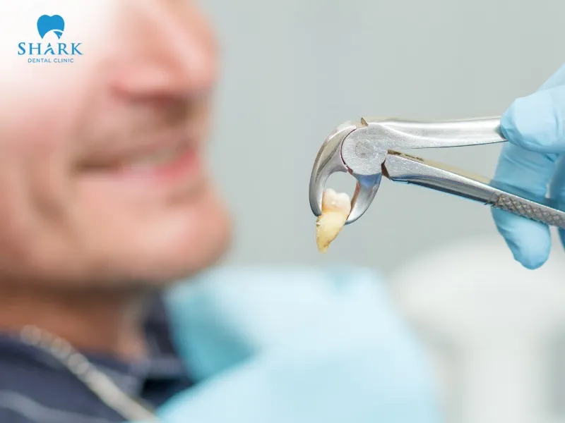 Tooth extraction is indicated for cases involving fractured teeth, severe tooth decay, or serious dental infections.