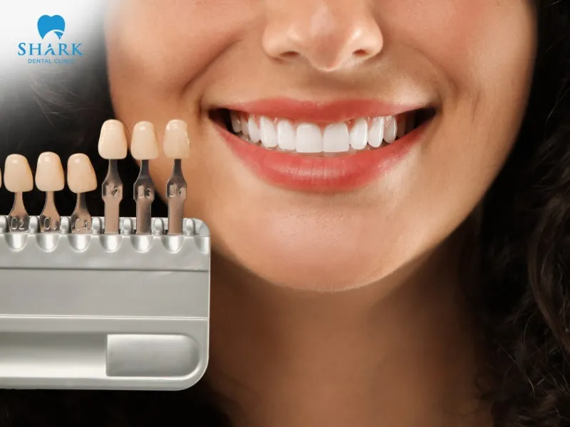 Veneer application offers high aesthetic value and is minimally invasive, preserving the original tooth structure.