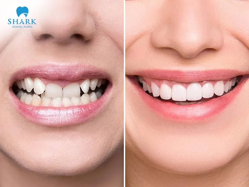 The porcelain crowns cost front teeth typically range from $38 to $573 per tooth.