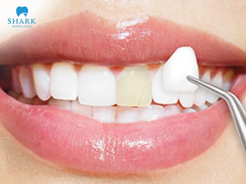 Several factors affect the porcelain crowns cost front teeth, such as the number of teeth and the dental clinic you choose.