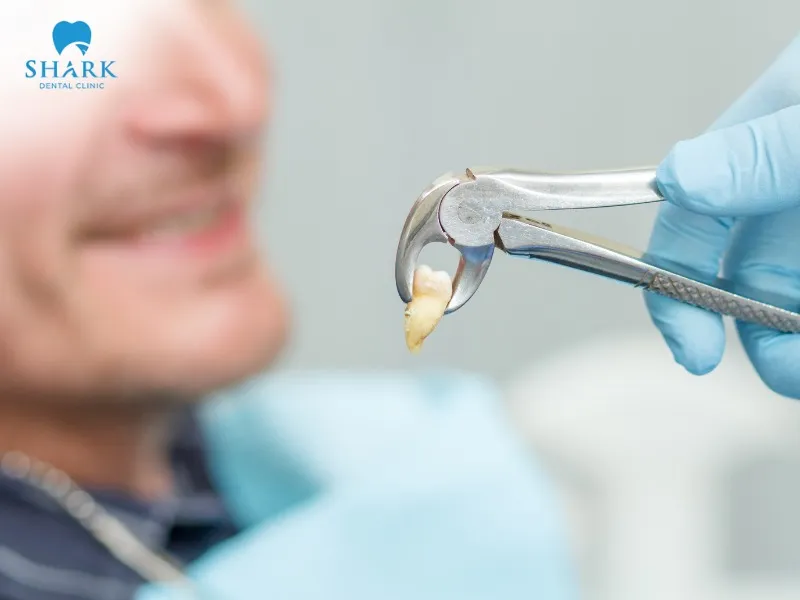 Tooth extraction cost in Vietnam depends on dental condition and clinic location