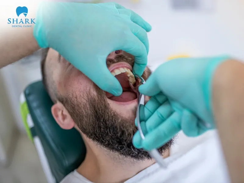 Insurance-covered extractions can range from $12 to $40, or be fully covered, depending on the procedure