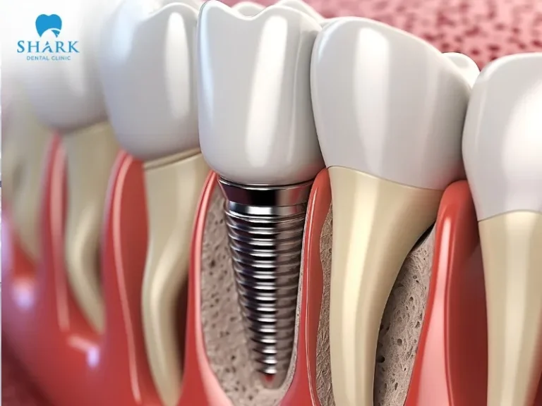 Dental implant treatment may cause some pain, but the discomfort usually decreases and completely subsides within about 7 days