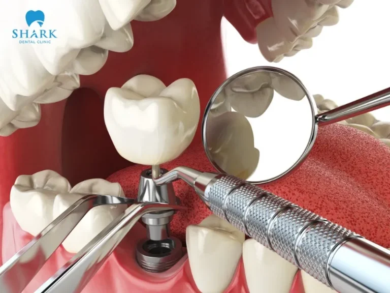 Before the implant procedure, patients are given anesthesia to minimize pain