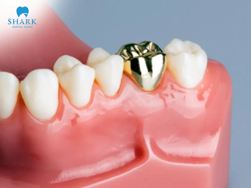 Gold crowns are a luxurious dental material known for their exceptional durability