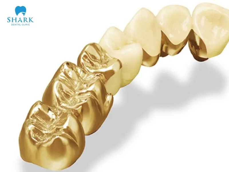 The cost of gold dental crowns is quite expensive and significantly higher than that of traditional porcelain materials.