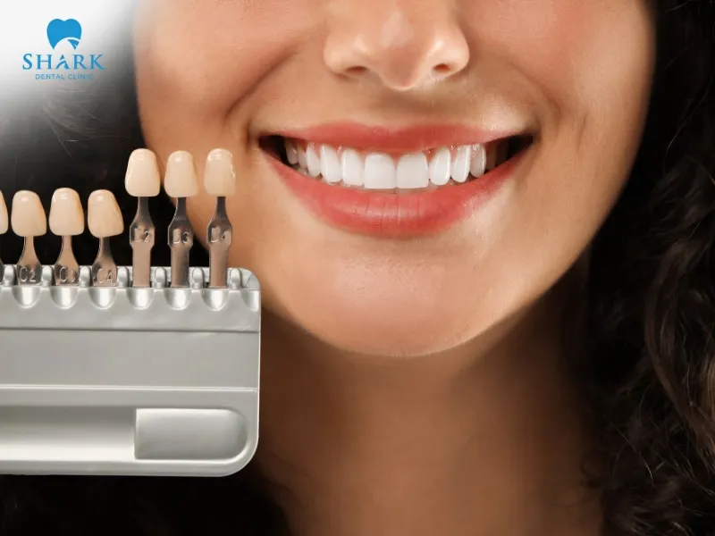 At reputable dental clinics, the dental veneer price in Vietnam typically ranges from $235 to $470