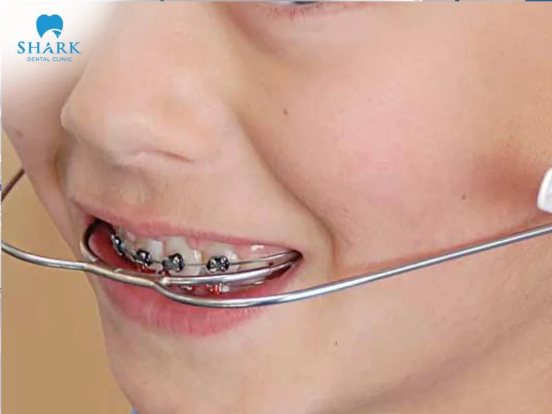 Orthodontic headgear helps correct bite misalignment and protrusion caused by jawbone issues, resulting in a more even and balanced set of teeth