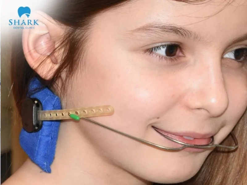 Depending on the bite misalignment condition, the dentist will recommend the most suitable type of orthodontic headgear for the patient