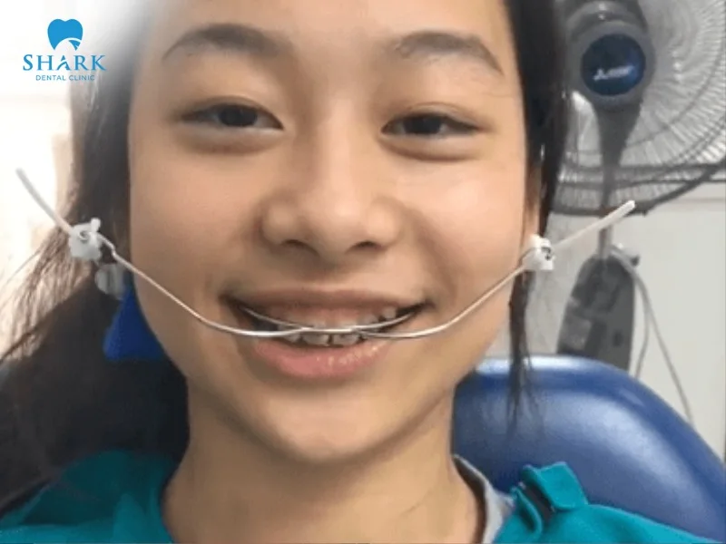 Headgear helps regulate jawbone growth and correct improperly positioned teeth