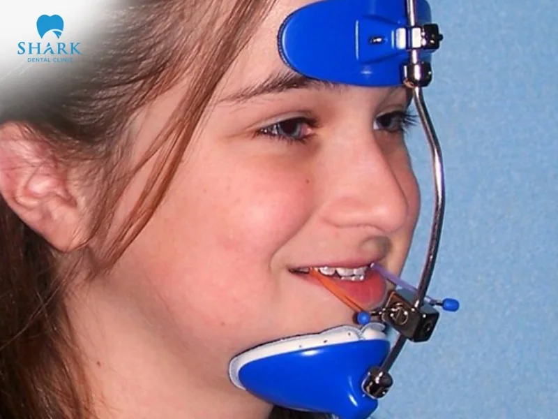 The duration of wearing headgear braces typically ranges from 12 to 18 months, depending on each individual case