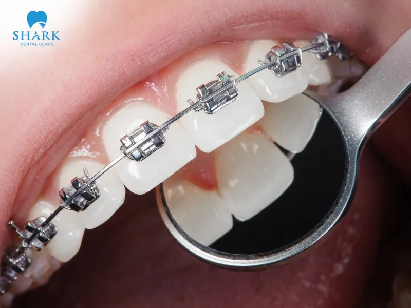 The cost of orthodontic treatment without insurance ranges from approximately $956 to $5,736 for both arches