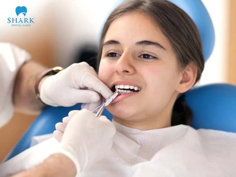 The price of braces at a dental clinic depends on various factors such as oral condition, dental materials used, and the clinic you choose