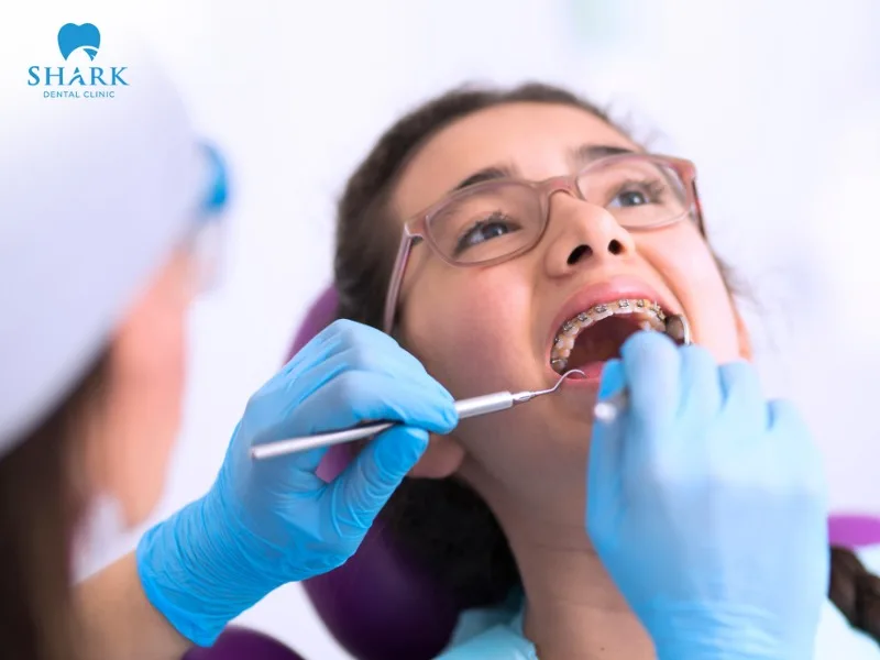 In Vietnam, cosmetic orthodontic treatments are not covered by health insurance