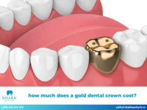 How much does a gold dental crown cost? Latest updated price list