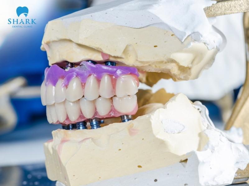 Zirconia crowns have a long lifespan, lasting up to 15–20 years or more depending on diet and oral care after restoration