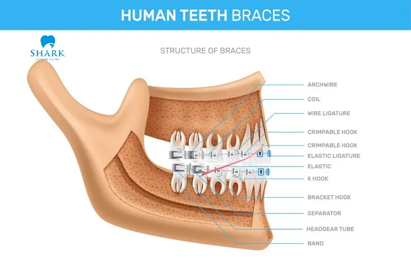Metal braces have a relatively complex structure