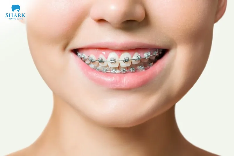 Metal braces use traditional orthodontic appliances to realign the teeth