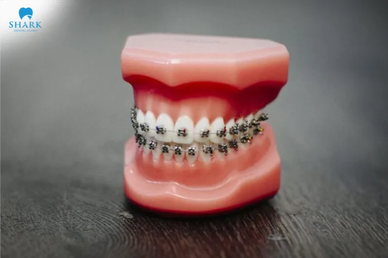 The main advantage of metal braces is their high orthodontic effectiveness