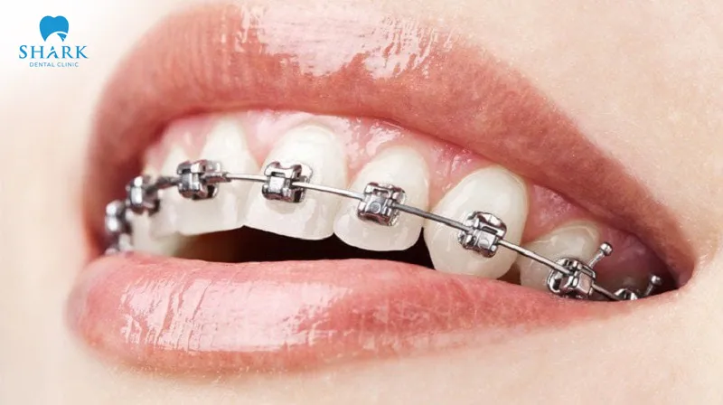 Metal braces are not highly rated in terms of aesthetics