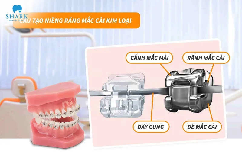 Metal braces have a relatively complex structure