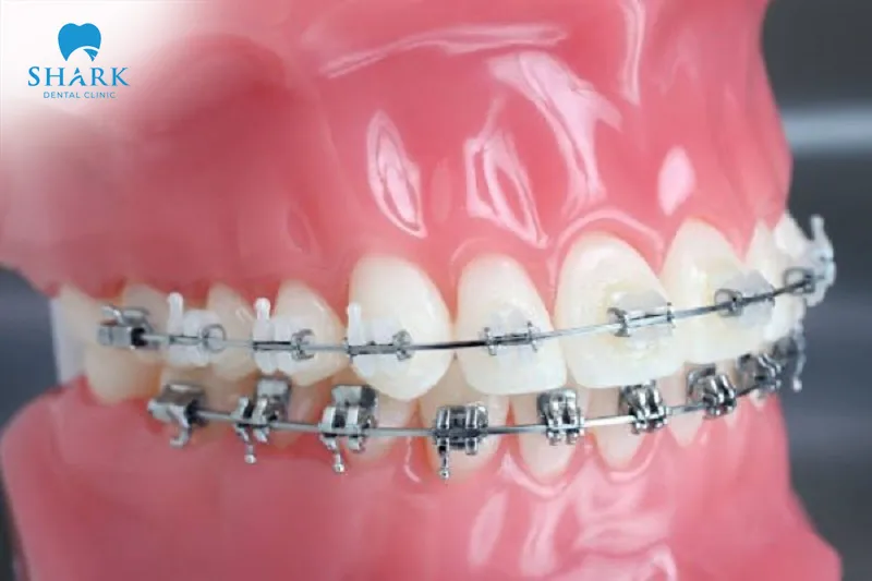 Self-ligating metal braces provide a more secure hold compared to traditional metal braces