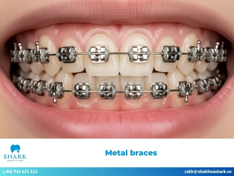 Metal Braces