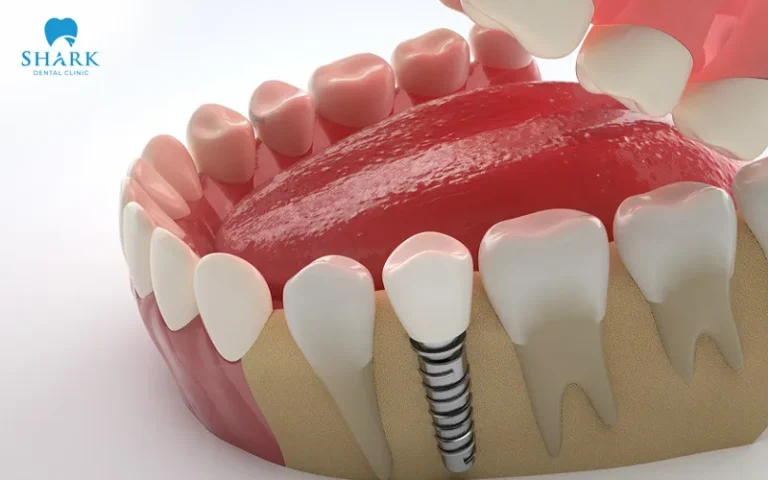 Single dental implants provide excellent aesthetics and can restore chewing function nearly as effectively as natural teeth