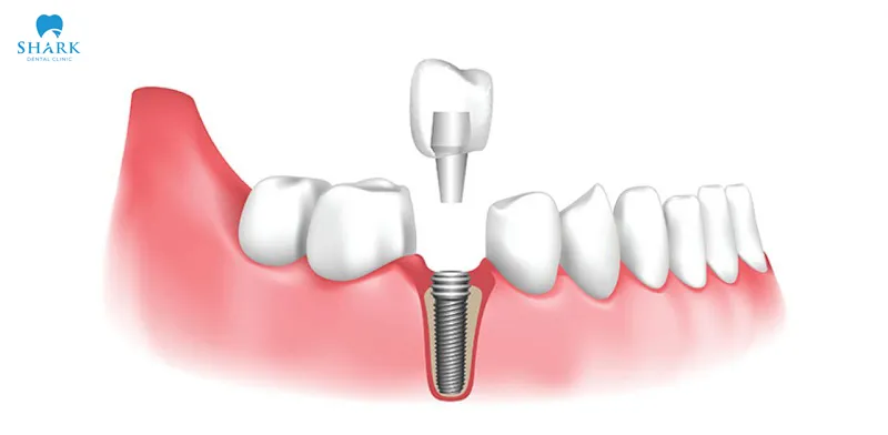 Porcelain restoration on implant is an essential step that ensures proper chewing function