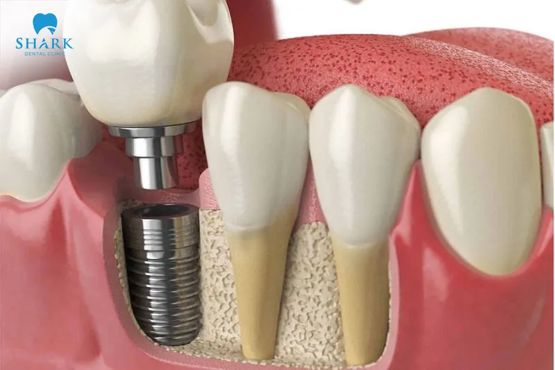 Once restored, porcelain teeth offer high aesthetic value and minimize discomfort