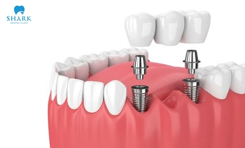The porcelain restoration process on implants is carried out according to strict quality standards