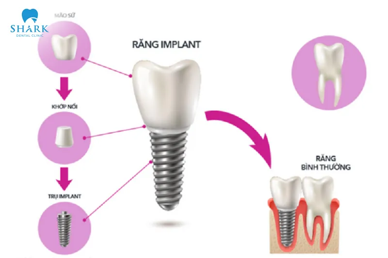 The cost of porcelain restoration depends on the type of material used and the dental clinic performing the procedure