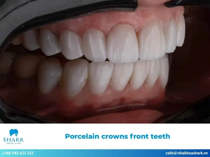Porcelain crowns front teeth