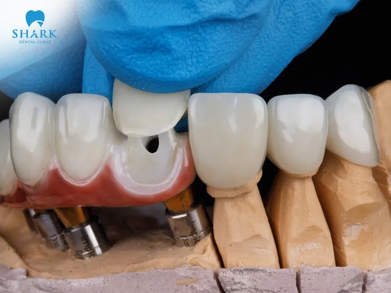 All-ceramic crowns have a longer lifespan than metal-ceramic crowns