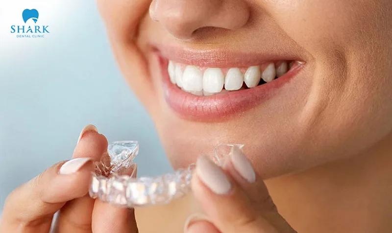 Removable braces make it easy to clean and eat, as the aligner trays are designed to be detachable