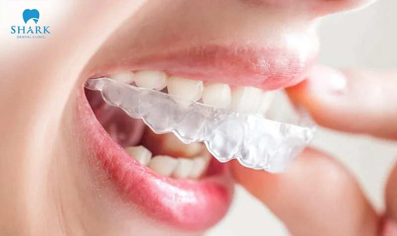 Removable braces are chosen for their safety and high aesthetic value