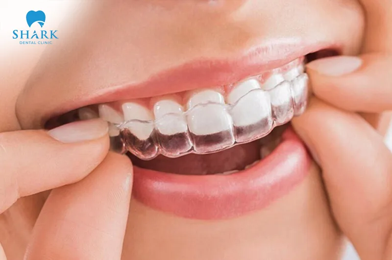 They work through gentle pressure applied by the aligner trays to gradually move the teeth