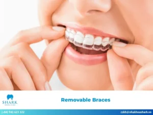 Removable braces