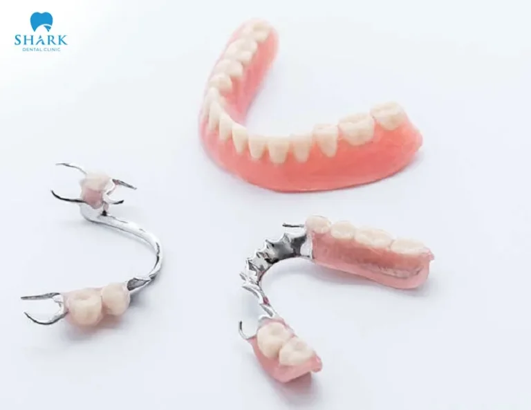 Removable partial denture with metal framework for partial edentulism