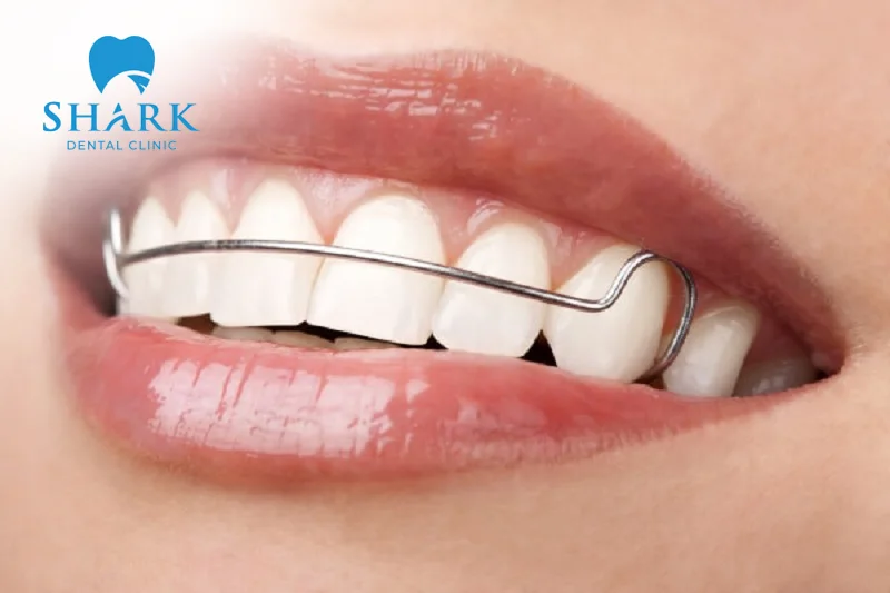 Retainers after braces help stabilize teeth and minimize shifting