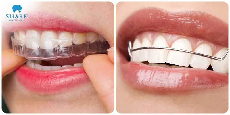 There are different types of retainers after braces to choose